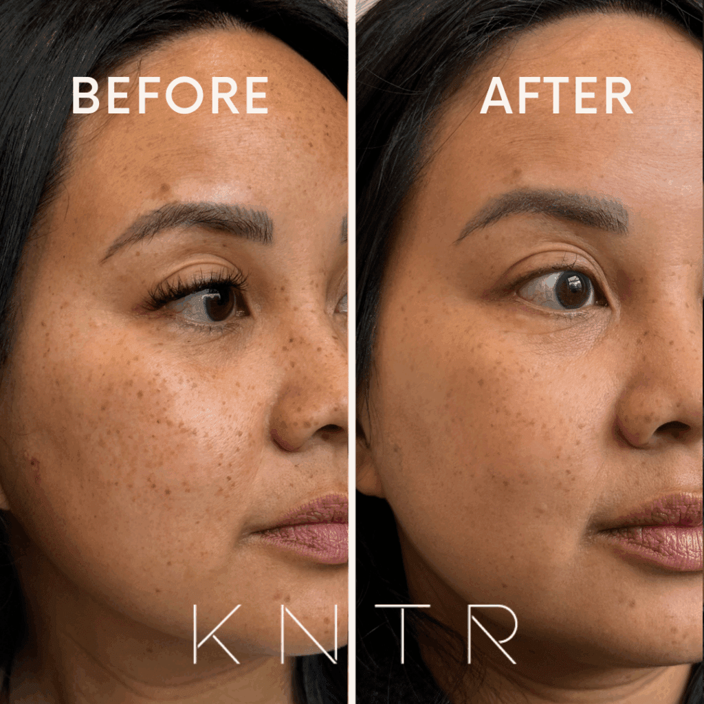 Natural Moxi Laser results showing softened, lighter freckles while maintaining a healthy, even complexion.